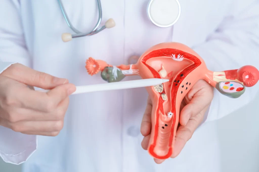 Fibroids